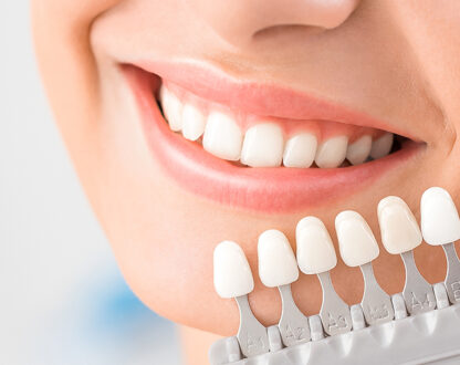 What are Veneers and How Long Do They Last?