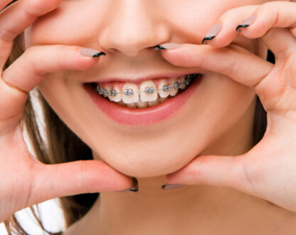 Did You Know That Fake Braces Can Be Very Dangerous For Your Dental Health