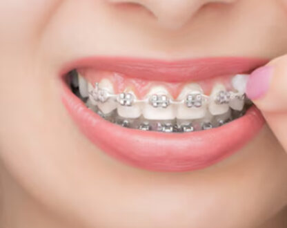 What Is Dental Wax, And How Can You Use it With Braces?