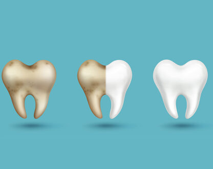Cavity vs Stain: How to Tell The Two Apart