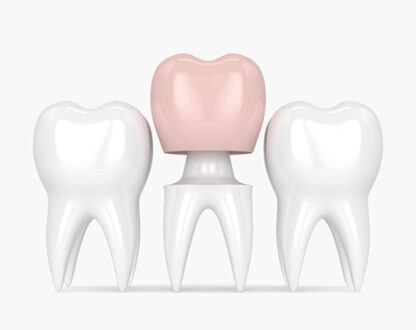 No Pain, All Gain: Does Getting A Crown Hurt?