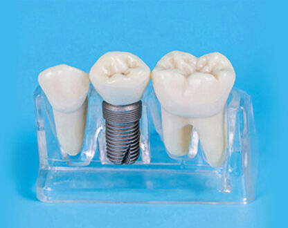 Crown Feels Loose But Isn't- What to do