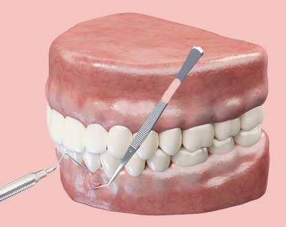 Is Gum Grafting Painful? Here’s What You Need to Know