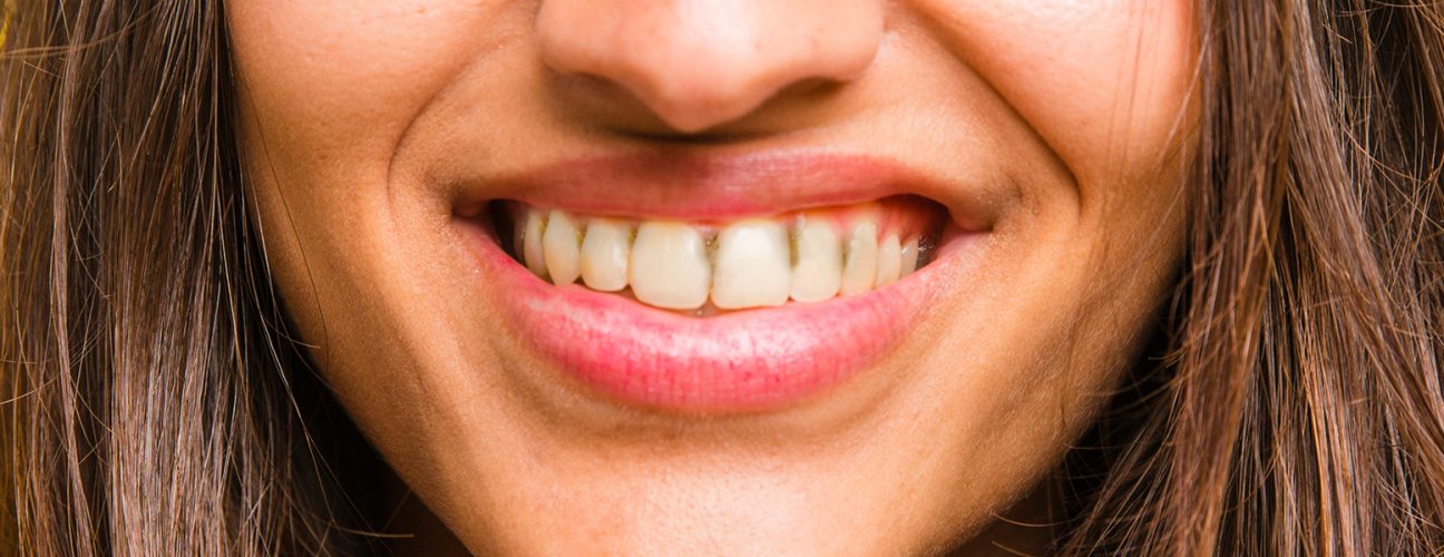 How To Get Rid of Black Tartar on Teeth