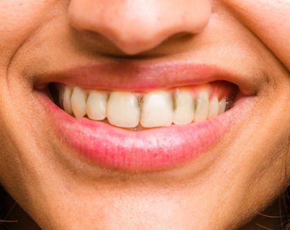 How To Get Rid of Black Tartar on Teeth
