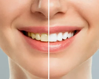 The Truth About Teeth Whitening: What Sugar Land Patients Need to Know