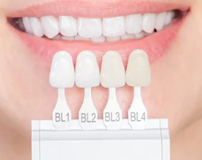 Veneers or Bonding? How to Choose the Right Cosmetic Treatment