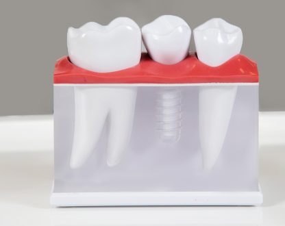Struggling with Tooth Loss? Here’s Why Implants Are a Good Option