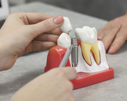 Say Goodbye to Gaps: Why Dental Implants Are Worth It