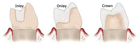 dental-inlay-onlay-and-crown