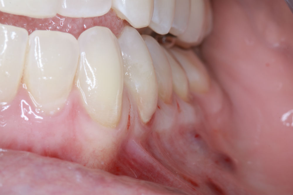 Case One: Free Gingival Graft Procedure