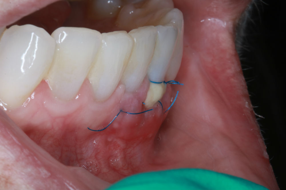 Case Two: Free Gingival Graft Procedure